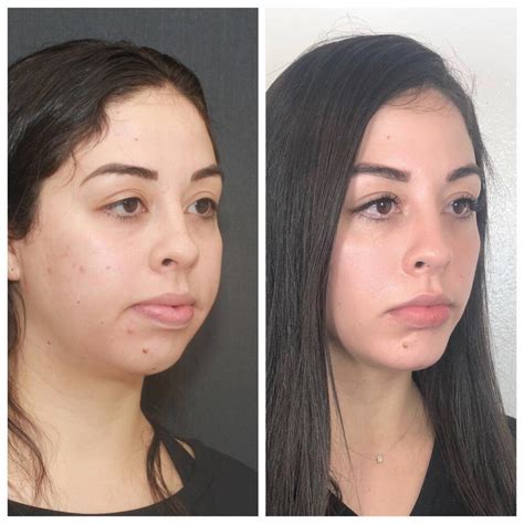 buccal fat removal mexico city  Buccal Fat Pad Removal, before and after illustration